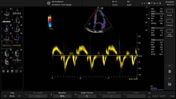 Versana Active™  Laptop-Farbultraschallsystem Demosystem – Bild 8