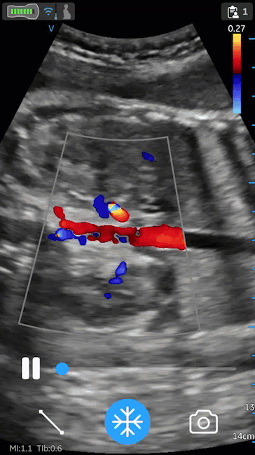 Fötale Nieren mit Nierengefäßen am Ultraschallsystem Vscan Air von GE Healthcare